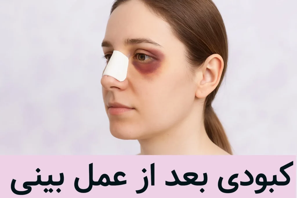از علت کبودی بعد از عمل بینی تا روش رفع آن را بدانید! 1 کبودی بعد از عمل بینی