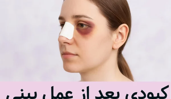 کبودی بعد از عمل بینی
