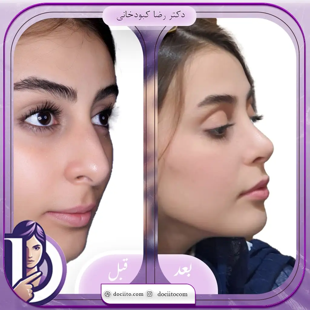 نمونه عمل بینی در شیراز دکتر کبودخانی