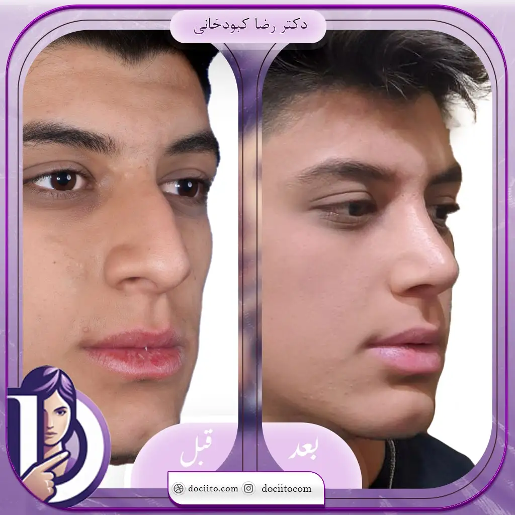 نمونه عمل بینی در شیراز دکتر کبودخانی